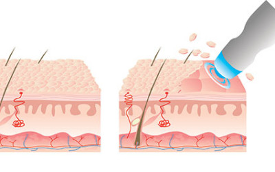 Microdermabrasion, the benefits for problem skin