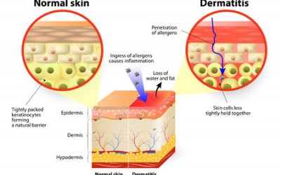 Sensitive Skin or Sensitised, whats the difference?