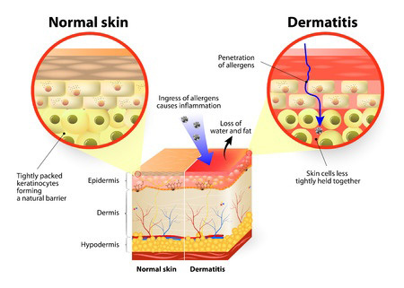 Diagram of causes of sensitive skin