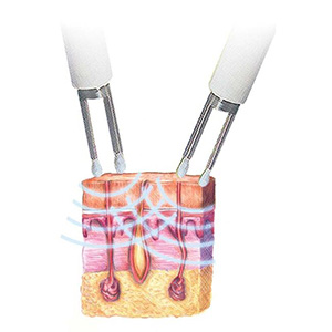 CACI Specialist Micro current