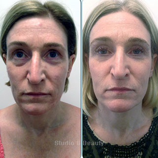 CACI Specialist treatment client 1 before and after pictures
