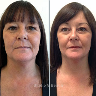 CACI Specialist treatment client 2 before and after pictures