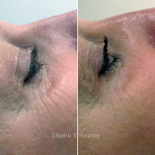 CACI Specialist treatment client 3 before and after pictures