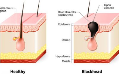 Blackheads: causes, treatment, prevention