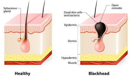 drawing showing blackheads