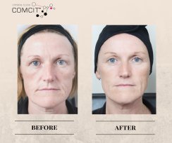 COMCIT Facial before and after images 1