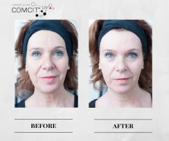 COMCIT Facial before and after images 2