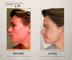 COMCIT Facial before and after images 3