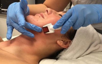 What is Microneedling ?