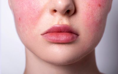 What is rosacea, and how can AlumierMD skincare help