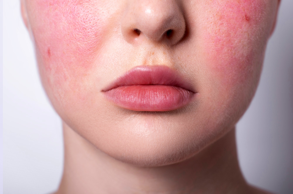 Rosacea on the face