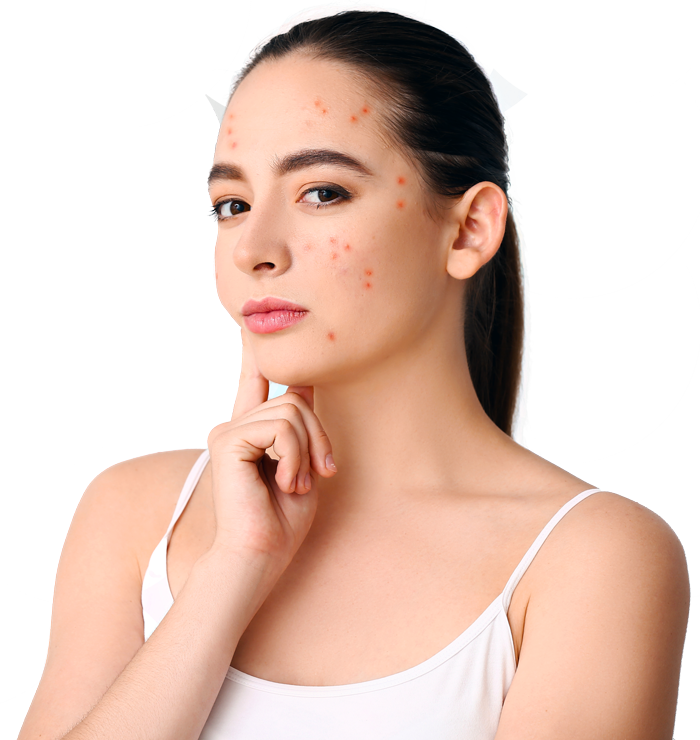 Woman with Adult Acne