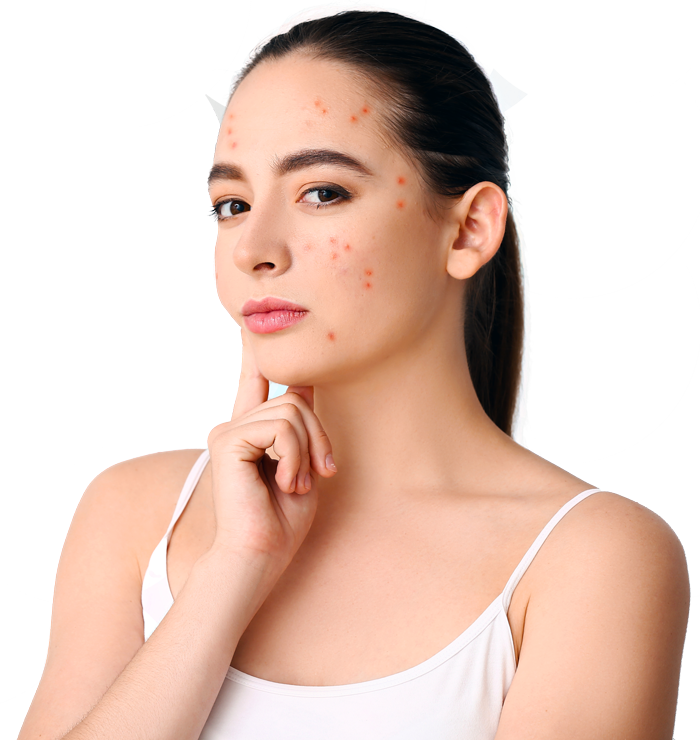 Adult Acne A Guide To Help You With The Condition To Improve Confidence 7133