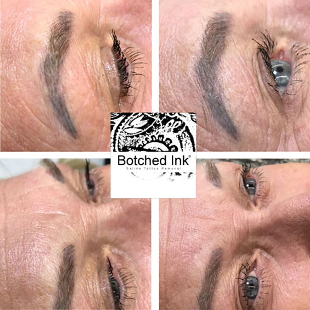 Permanent Makeup Botched Ink Removal Stages