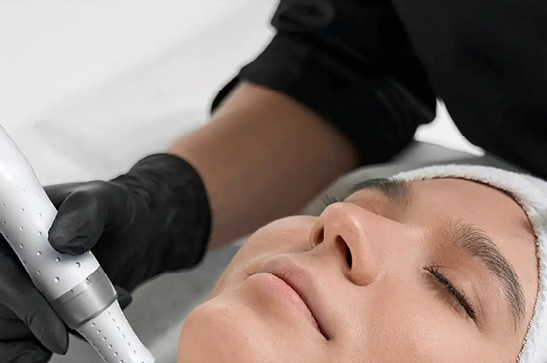 Microneedling on a client