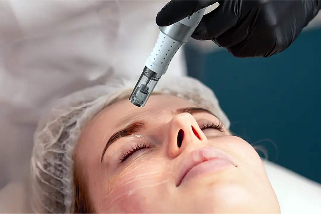 Microneedling on a client's forehead